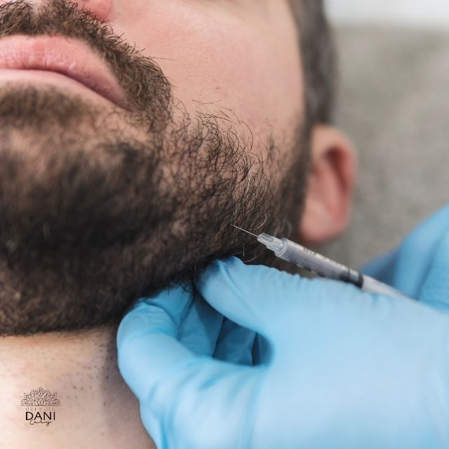 Parte inferior de um rosto de homem com barba, recebendo aplicação de produto para preenchimento facial na região maxilar