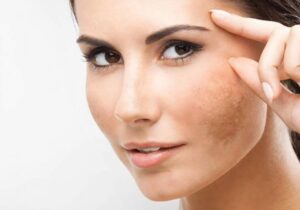 Desenvolvimento de melasma